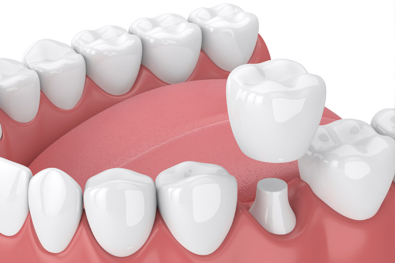 Dental Crowns in Portage