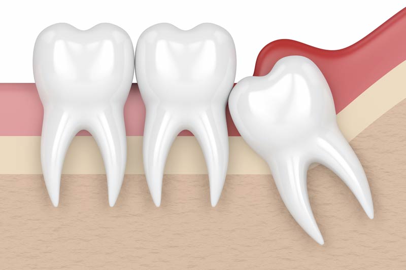 Wisdom Tooth Removal in Portage